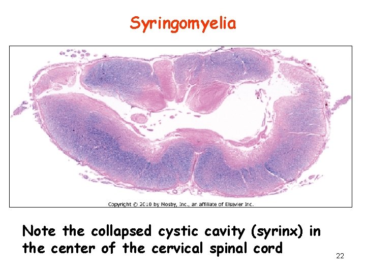Syringomyelia Note the collapsed cystic cavity (syrinx) in the center of the cervical spinal