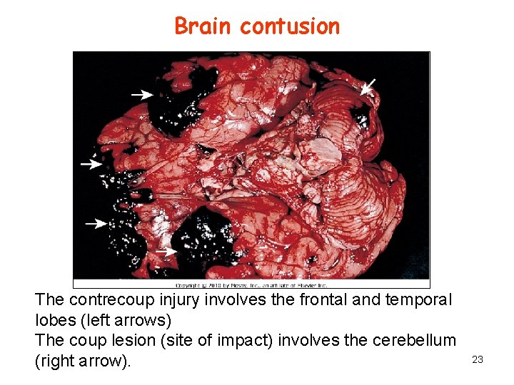 Brain contusion The contrecoup injury involves the frontal and temporal lobes (left arrows) The
