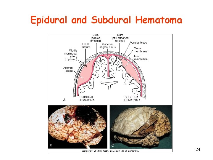 Epidural and Subdural Hematoma 24 
