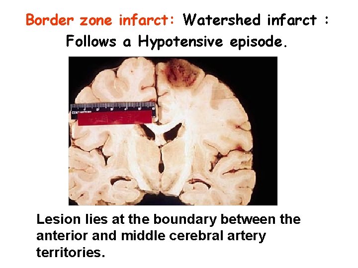 Border zone infarct: Watershed infarct : Follows a Hypotensive episode. Lesion lies at the