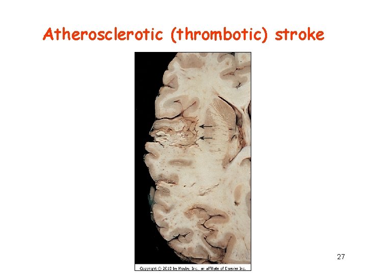 Atherosclerotic (thrombotic) stroke 27 