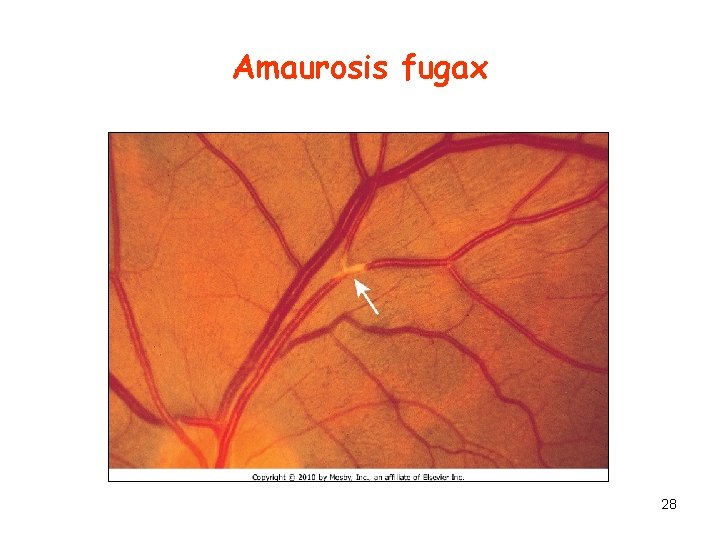 Amaurosis fugax 28 