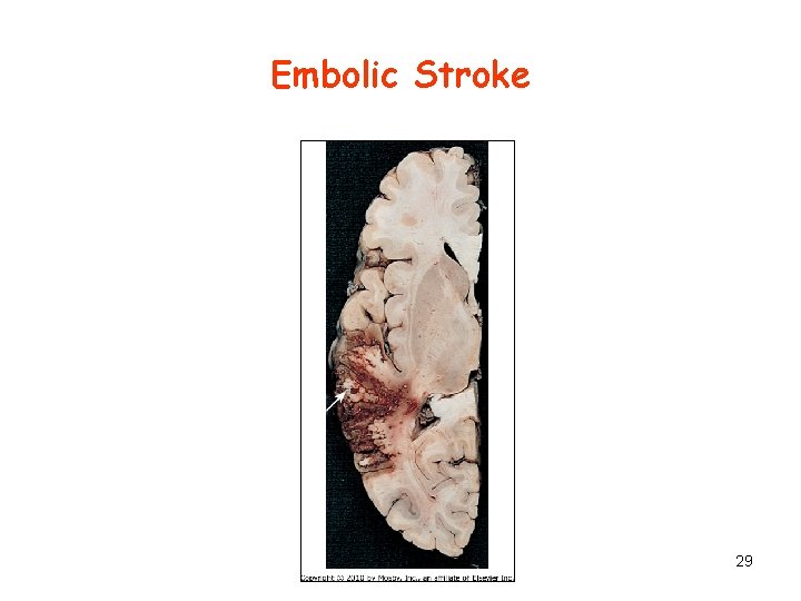 Embolic Stroke 29 