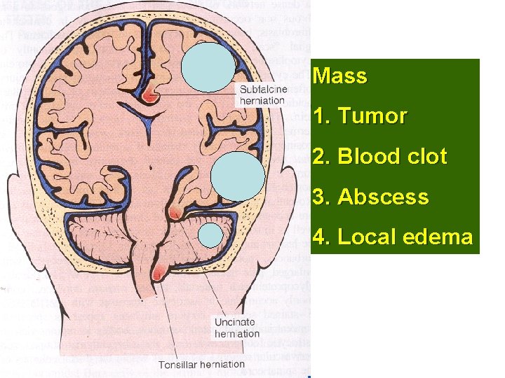 Mass S 1. Tumor 2. Blood clot 3. Abscess 4. Local edema T 