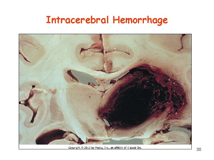 Intracerebral Hemorrhage 30 