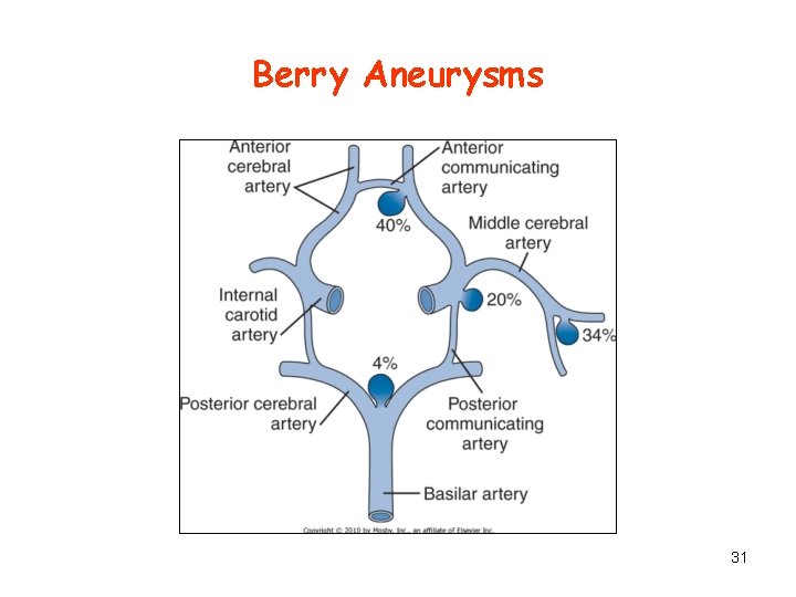 Berry Aneurysms 31 