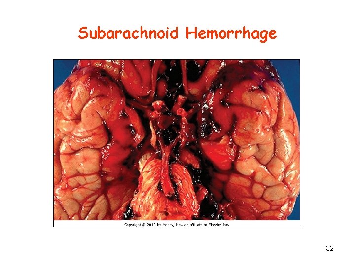 Subarachnoid Hemorrhage 32 