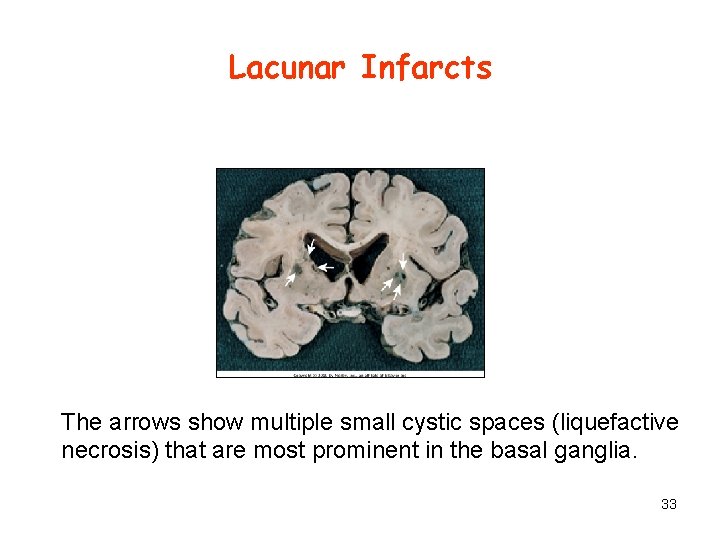 Lacunar Infarcts The arrows show multiple small cystic spaces (liquefactive necrosis) that are most