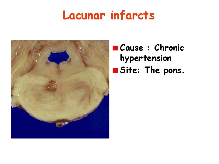 Lacunar infarcts Cause : Chronic hypertension Site: The pons. 