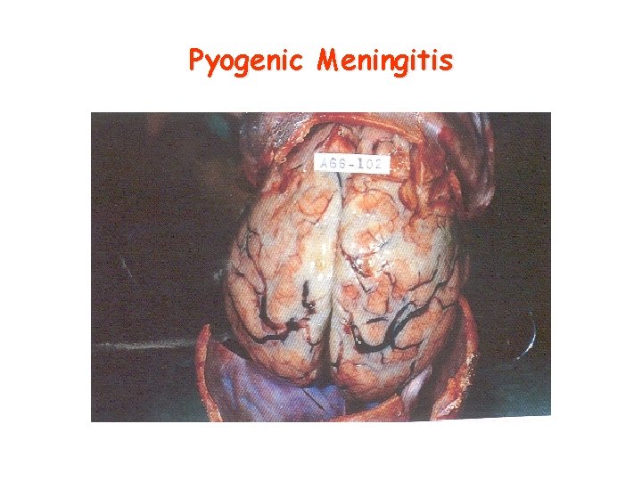 Pyogenic Meningitis 