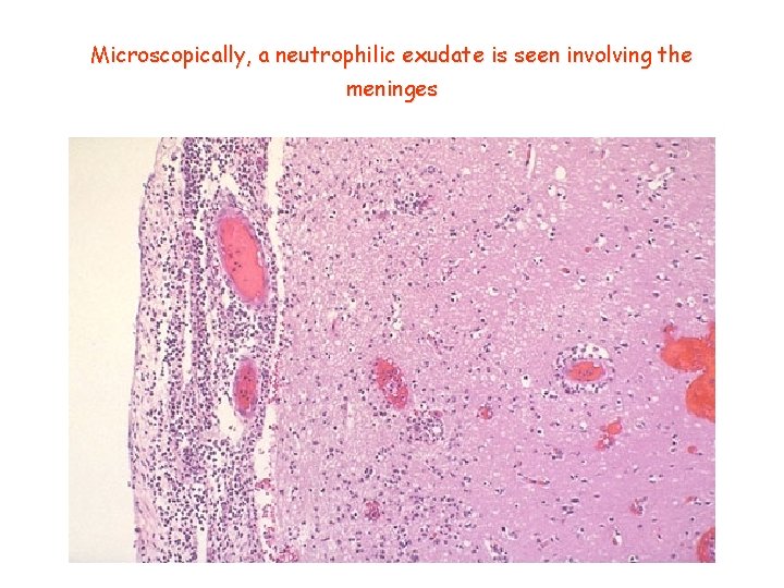 Microscopically, a neutrophilic exudate is seen involving the meninges 
