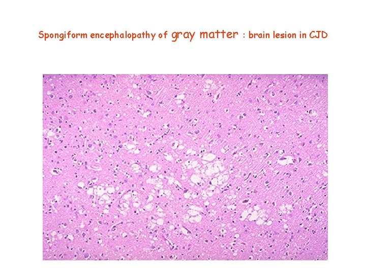 Spongiform encephalopathy of gray matter : brain lesion in CJD 