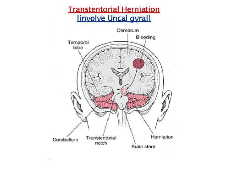 Transtentorial Herniation [involve Uncal gyral] 