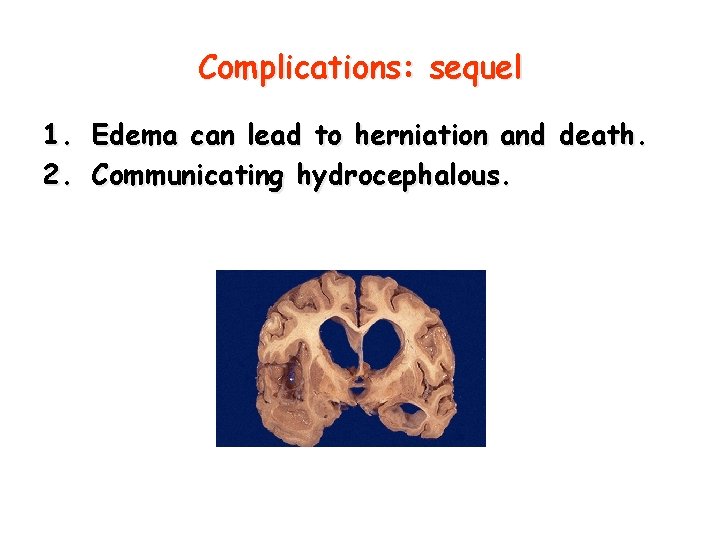Complications: sequel 1. Edema can lead to herniation and death. 2. Communicating hydrocephalous. 