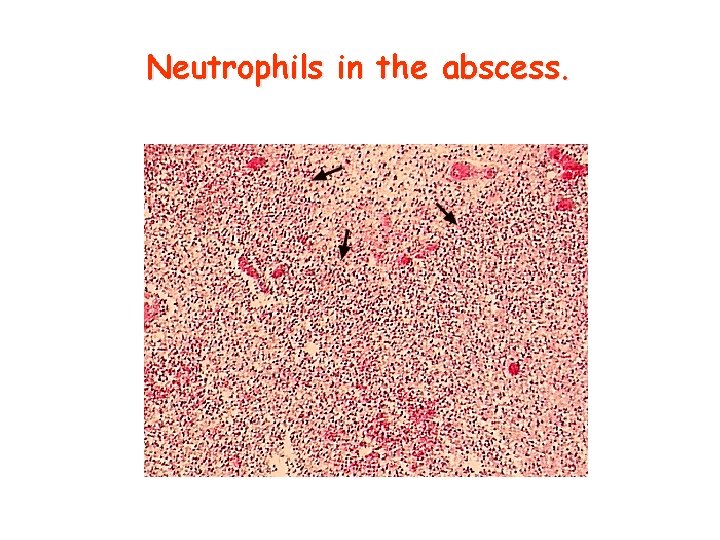 Neutrophils in the abscess. 