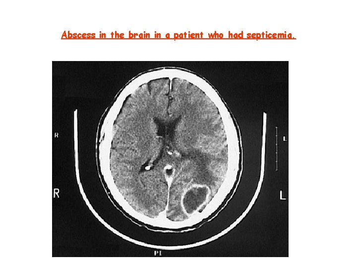 Abscess in the brain in a patient who had septicemia. 