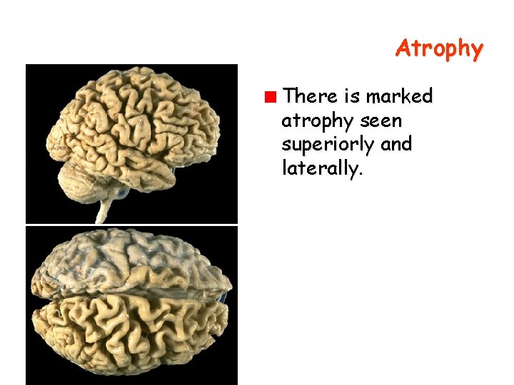 Atrophy There is marked atrophy seen superiorly and laterally. 