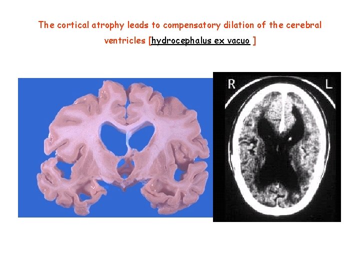 The cortical atrophy leads to compensatory dilation of the cerebral ventricles [hydrocephalus ex vacuo