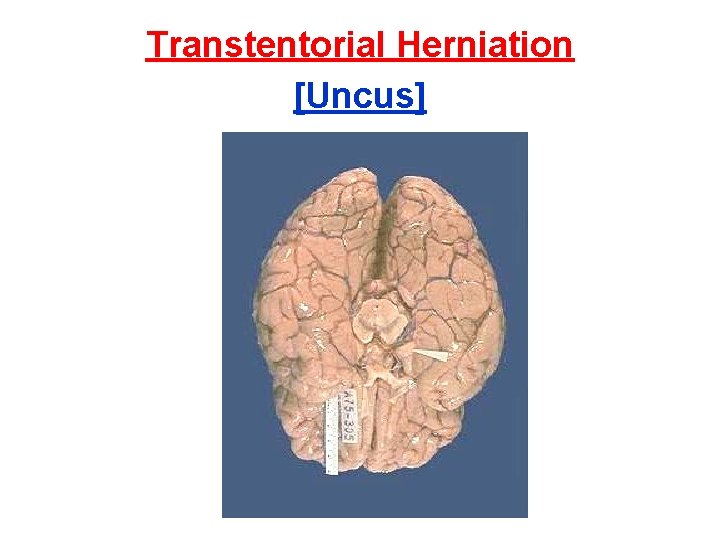 Transtentorial Herniation [Uncus] 