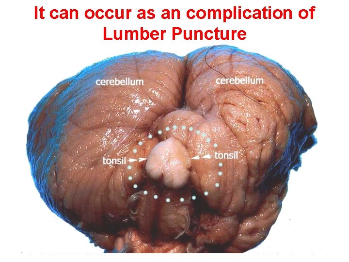 It can occur as an complication of Lumber Puncture 