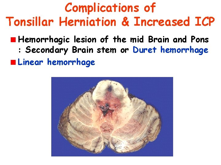 Complications of Tonsillar Herniation & Increased ICP Hemorrhagic lesion of the mid Brain and