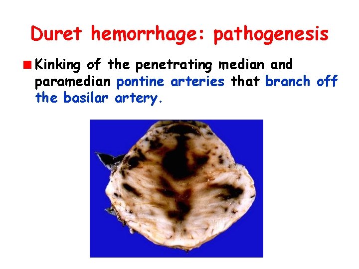 Duret hemorrhage: pathogenesis Kinking of the penetrating median and paramedian pontine arteries that branch