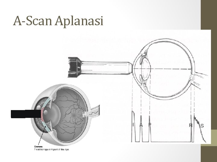 A-Scan Aplanasi A-Scan Aplanasi