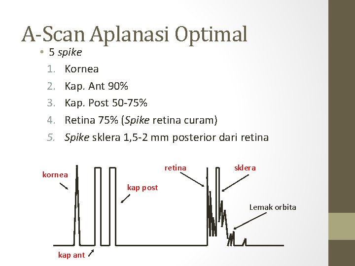 A-Scan Aplanasi Optimal • 5 spike 1. Kornea 2. Kap. Ant 90% 3. Kap.