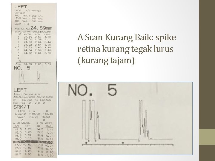 A Scan Kurang Baik: spike retina kurang tegak lurus (kurang tajam) A Scan Kurang Baik: spike retina kurang tegak lurus (kurang tajam)
