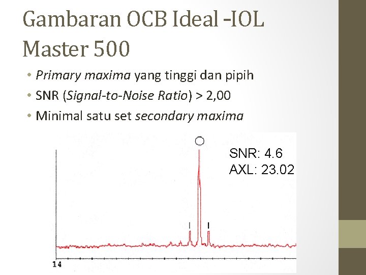 Gambaran OCB Ideal –IOL Master 500 • Primary maxima yang tinggi dan pipih • Gambaran OCB Ideal –IOL Master 500 • Primary maxima yang tinggi dan pipih •