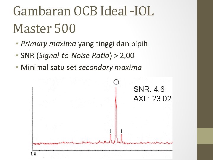 Gambaran OCB Ideal –IOL Master 500 • Primary maxima yang tinggi dan pipih •