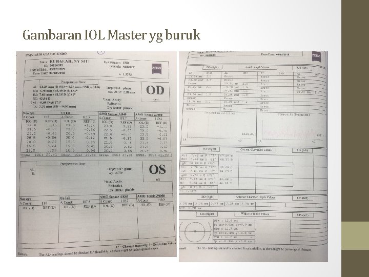 Gambaran IOL Master yg buruk 