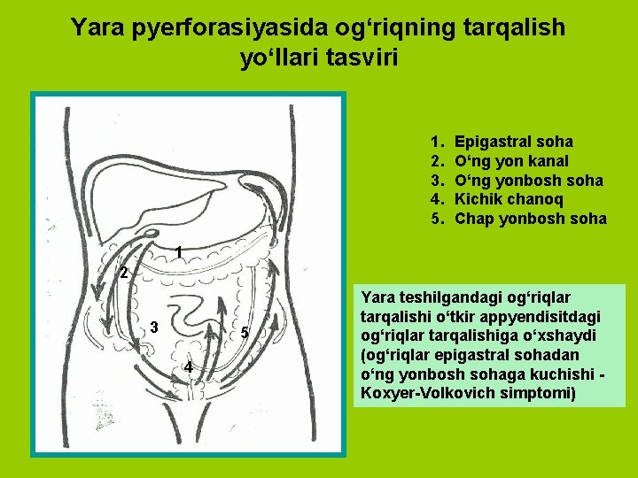 Yara pyerforasiyasida og‘riqning tarqalish yo‘llari tasviri 1. 2. 3. 4. 5. Epigastral soha O‘ng