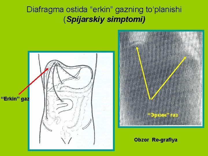 Diafragma ostida “erkin” gazning to‘planishi (Spijarskiy simptomi) “Erkin” gaz “Эркин” газ Obzor Re-grafiya 