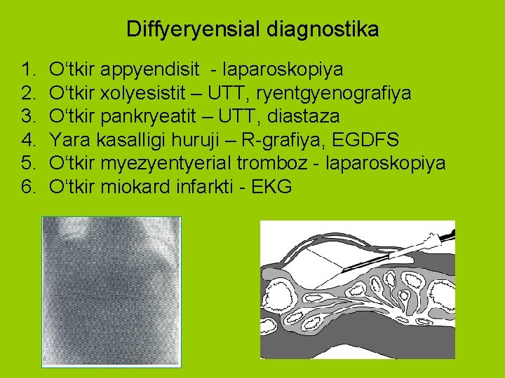 Diffyeryensial diagnostika 1. 2. 3. 4. 5. 6. O‘tkir appyendisit - laparoskopiya O‘tkir xolyesistit