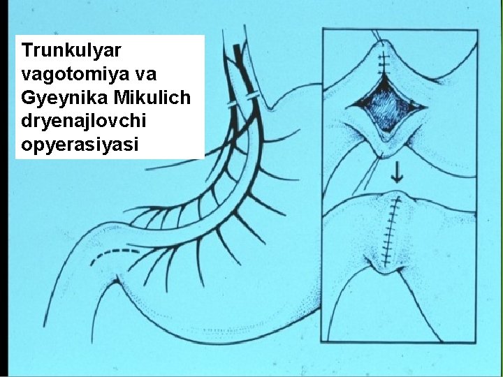 Trunkulyar vagotomiya va Gyeynika Mikulich dryenajlovchi opyerasiyasi 