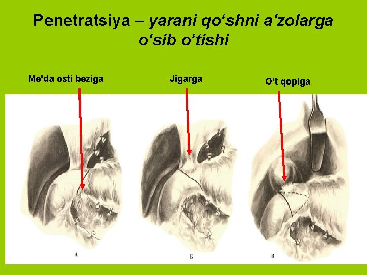 Penetratsiya – yarani qo‘shni a'zolarga o‘sib o‘tishi Me'da osti beziga Jigarga O‘t qopiga 