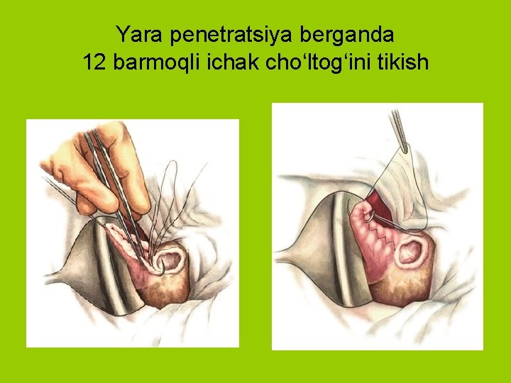 Yara penetratsiya berganda 12 barmoqli ichak cho‘ltog‘ini tikish 