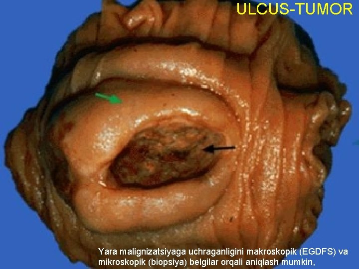 ULCUS-TUMOR Yara malignizatsiyaga uchraganligini makroskopik (EGDFS) va mikroskopik (biopsiya) belgilar orqali aniqlash mumkin, 