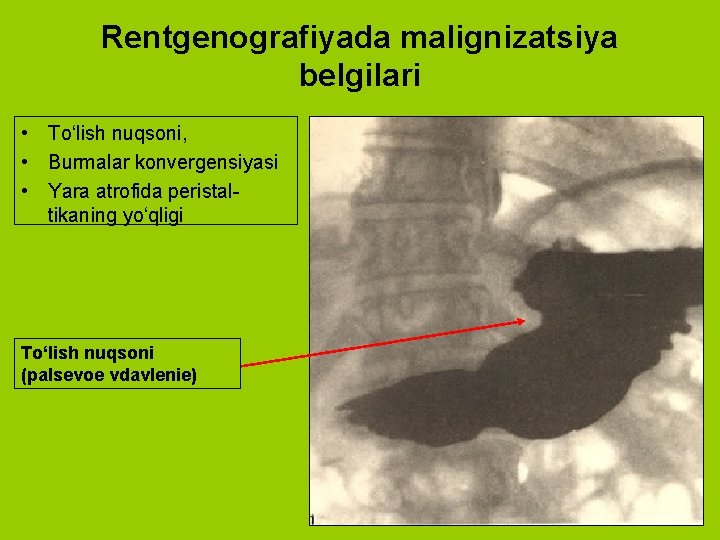 Rentgenografiyada malignizatsiya belgilari • To‘lish nuqsoni, • Burmalar konvergensiyasi • Yara atrofida peristaltikaning yo‘qligi