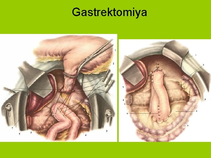 Gastrektomiya 