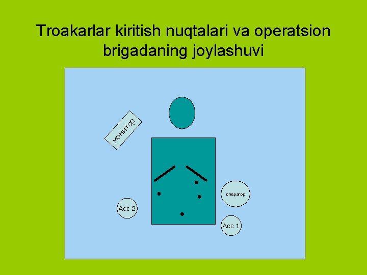 мо ни то р Troakarlar kiritish nuqtalari va operatsion brigadaning joylashuvi оператор Асс 2