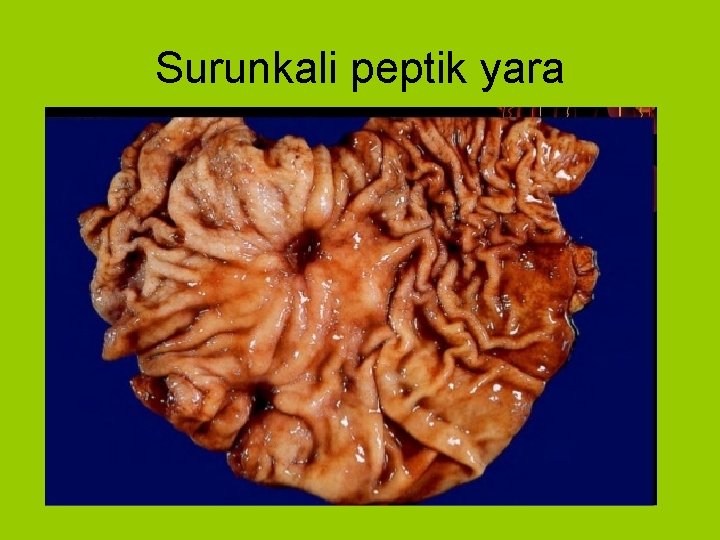 Surunkali peptik yara 