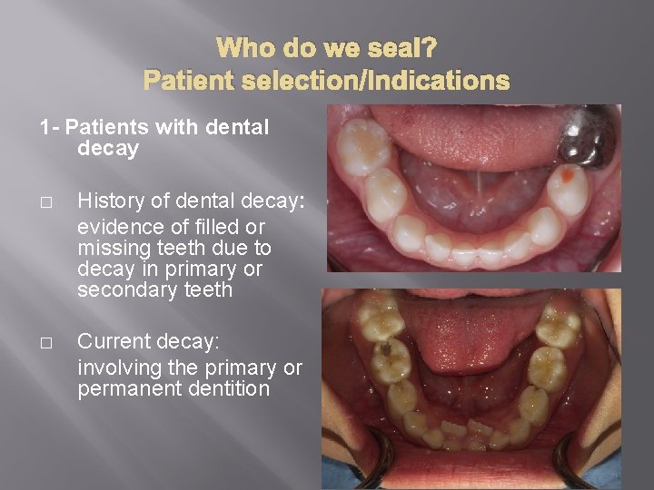 Who do we seal? Patient selection/Indications 1 - Patients with dental decay � History