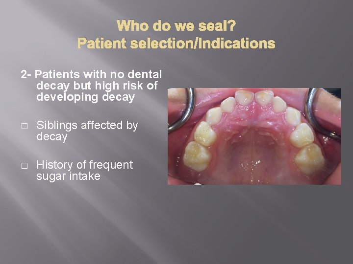 Who do we seal? Patient selection/Indications 2 - Patients with no dental decay but