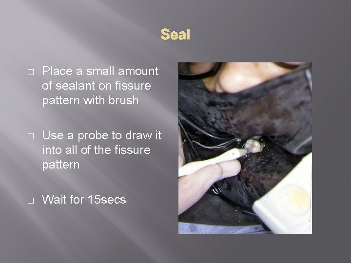Seal � Place a small amount of sealant on fissure pattern with brush �