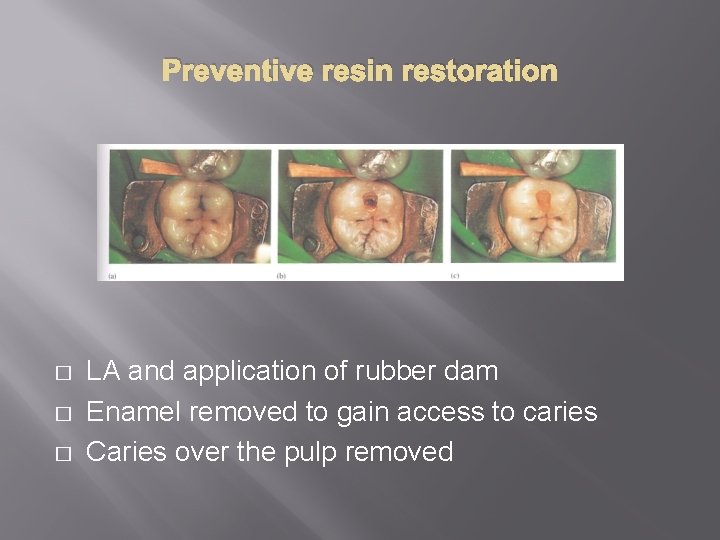 Preventive resin restoration � � � LA and application of rubber dam Enamel removed