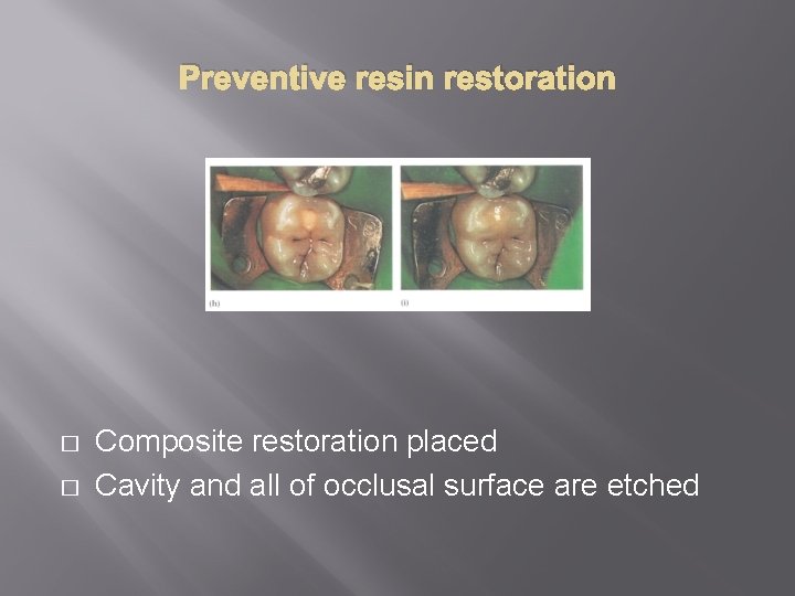 Preventive resin restoration � � Composite restoration placed Cavity and all of occlusal surface