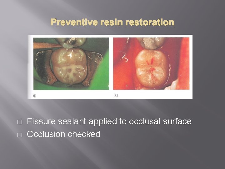 Preventive resin restoration � � Fissure sealant applied to occlusal surface Occlusion checked 