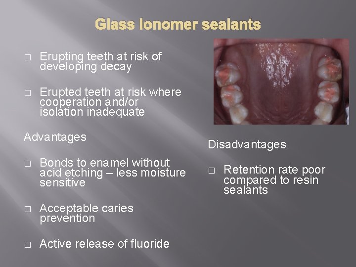 Glass Ionomer sealants � Erupting teeth at risk of developing decay � Erupted teeth